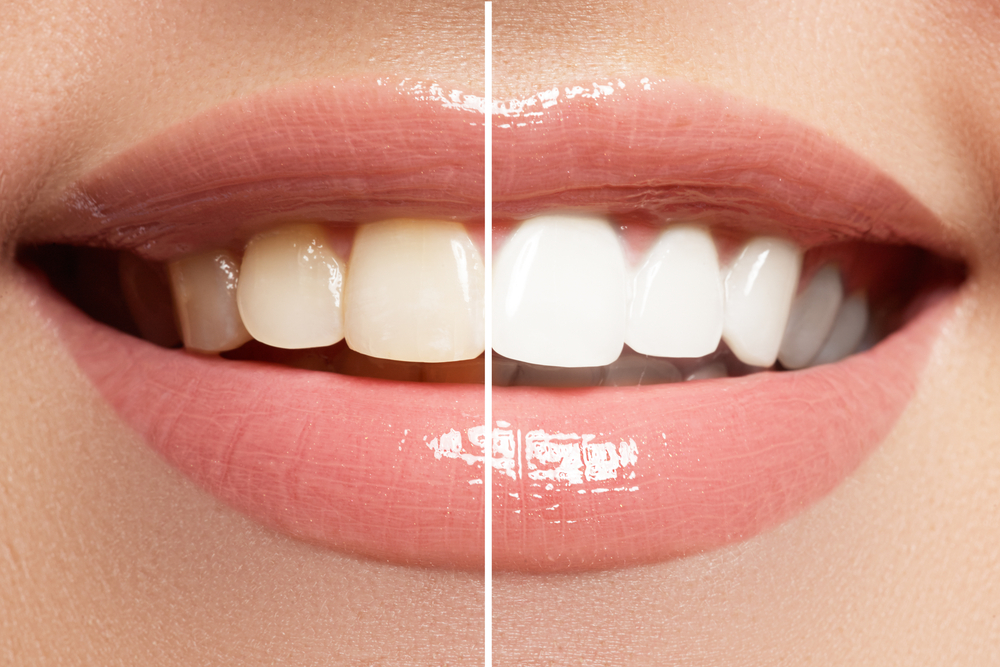 Valokuvassa, jossa hampaat valkaisemattomana ja valkaisun jälkeen.